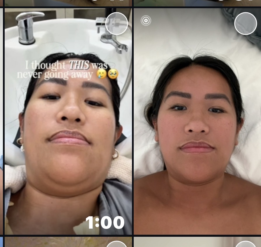 HIFU Treatment - Bangkok Travel Guide